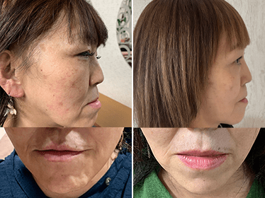 再生美容エステ